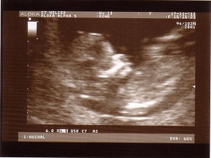 Ultrasound sonogram of a 12-week foetus